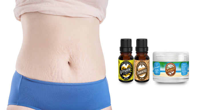 How to Use Frankincense Essential Oil for Stretch Marks